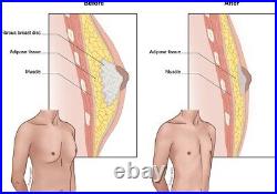 AI Ultrasonic Laser Cavitation Gynecomastia Breast Reduction FAT BURNER