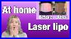 At_Home_Laser_Lipo_Radio_Frequency_Therapy_At_Home_Fat_Cavitation_Before_And_After_01_mlr