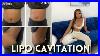 Lipo_Cavitation_Review_Does_It_Really_Work_Before_And_After_01_nra