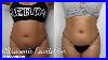 Ultrasonic_Cavitation_U0026_Laser_Lipo_Before_And_After_Photos_Full_Detailed_Video_01_vt
