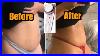 Weight_Loss_Journey_Instant_Flat_Stomach_No_Exercise_No_Diet_Laser_Lipo_At_Home_01_iip